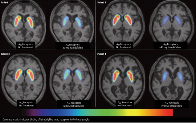 Positron-emission tomography (PET) imaging of adenosine A2A receptors in basal ganglia